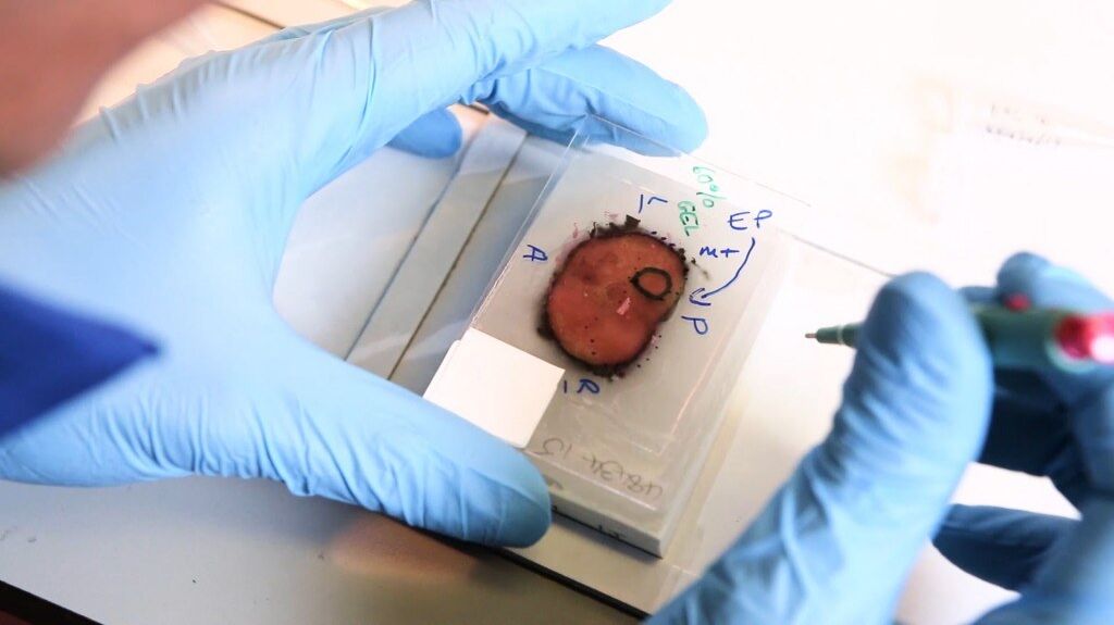 Histopathologist's hands holding a tumour sample slide
